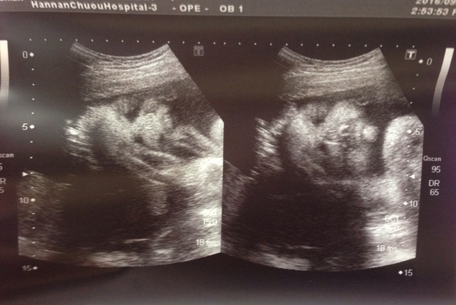 エコー写真 30週0日 30w0d 女の子,妊娠,30週,エコー写真
