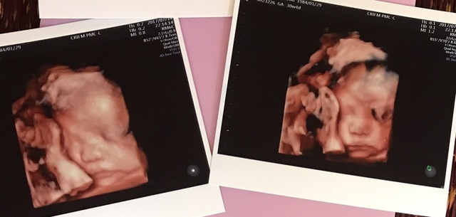 エコー写真 30週4日 30w4d 女の子,妊娠,30週,エコー写真