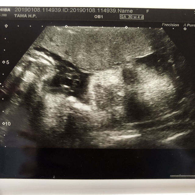 エコー写真 30週4日 30w4d 女の子,妊娠,30週,エコー写真