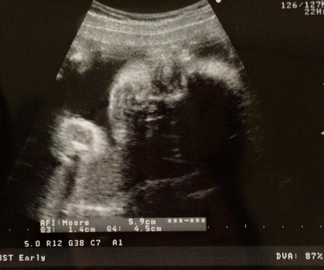 エコー写真 30週5日 30w5d 男の子,妊娠,30週,エコー写真