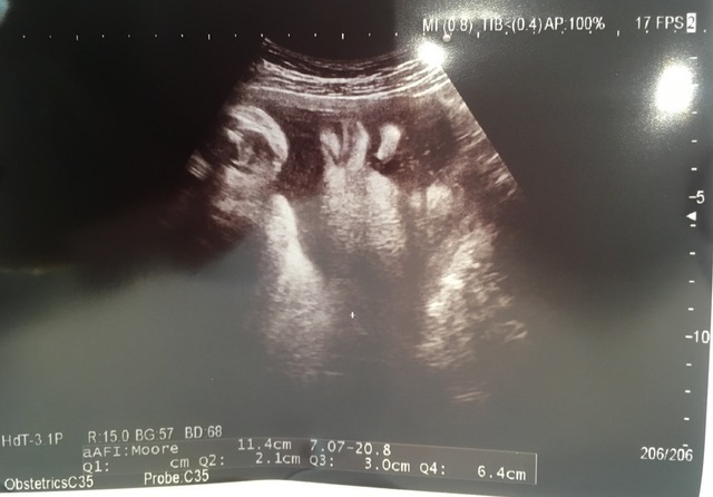 エコー写真 30週5日 30w5d 男の子,妊娠,30週,エコー写真