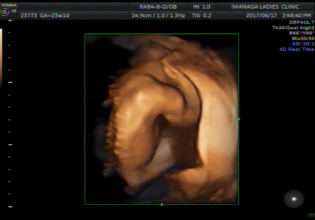 エコー写真 23週1日 23w1d 男の子,妊娠,23週,エコー写真