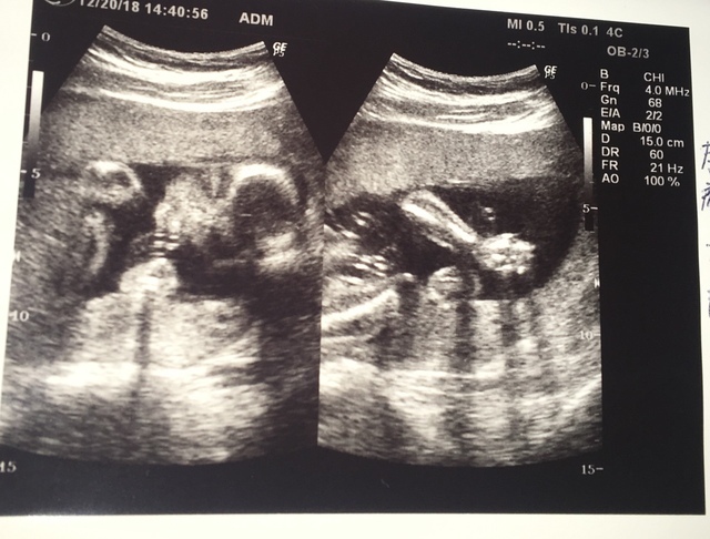 エコー写真 23週2日 23w2d 女の子,妊娠,23週,エコー写真