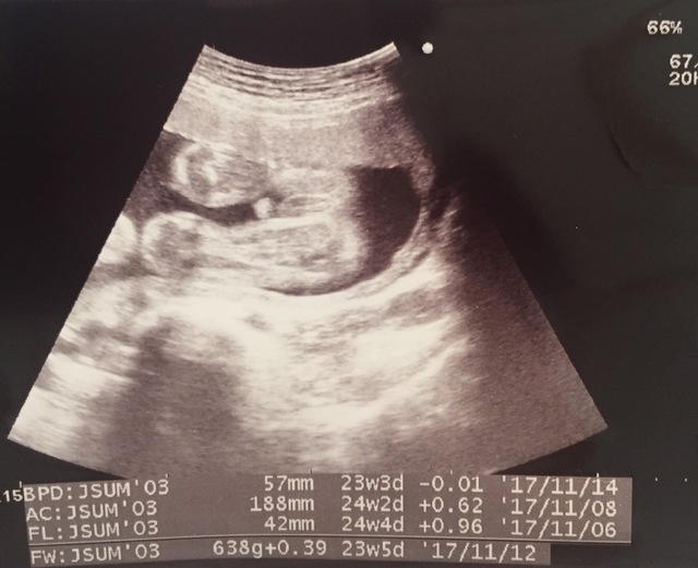 エコー写真 23週3日 23w3d 男の子,妊娠,23週,エコー写真