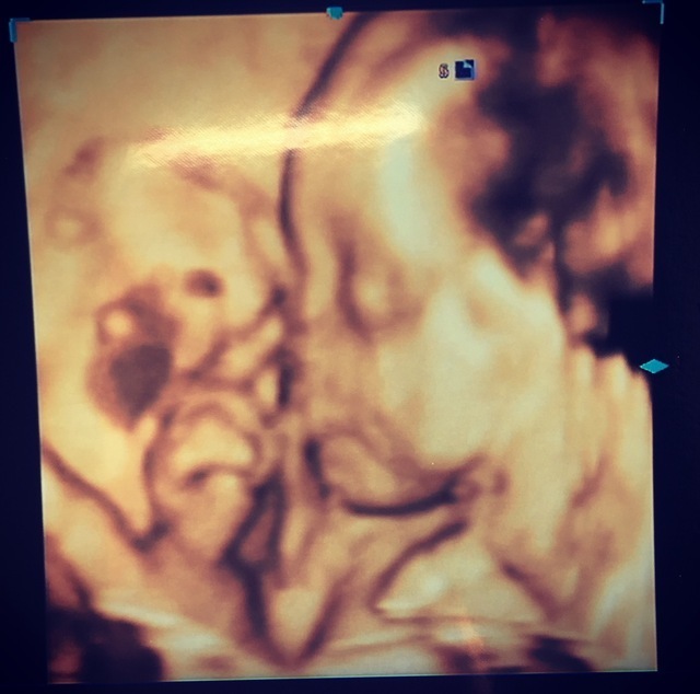 エコー写真 23週4日 23w4d 女の子,妊娠,23週,エコー写真