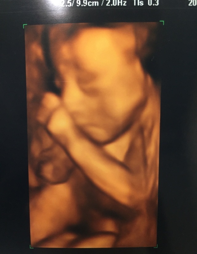 エコー写真 23週4日 23w4d 女の子,妊娠,23週,エコー写真