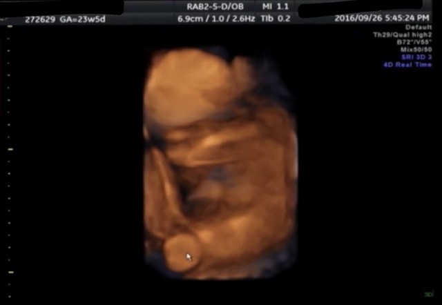 エコー写真 23週5日 23w5d 男の子,妊娠,23週,エコー写真
