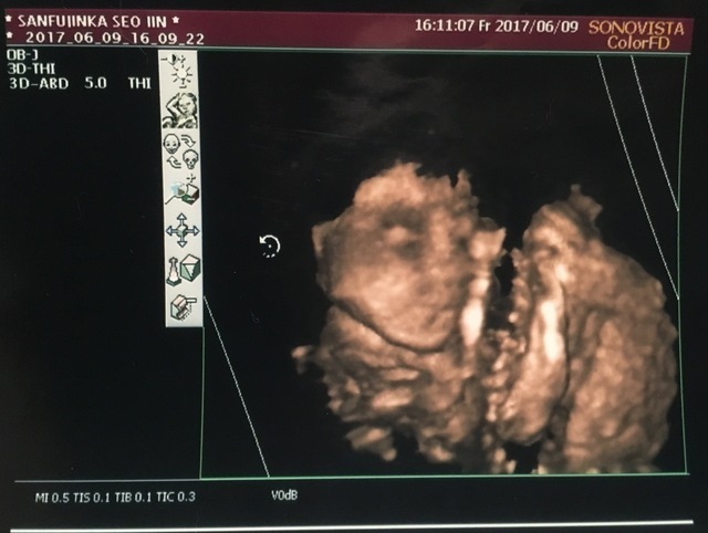 エコー写真 23週5日 23w5d 男の子,妊娠,23週,エコー写真