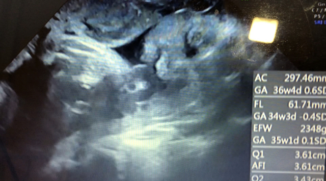 エコー写真 35週0日 35w0d 男の子,妊娠,35週,エコー写真