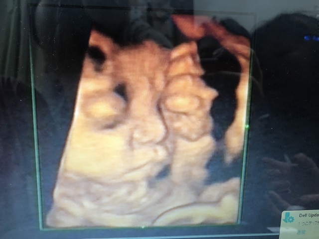 エコー写真 35週2日 35w2d 男の子,妊娠,35週,エコー写真