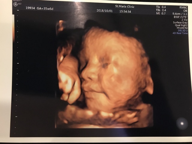 エコー写真 35週6日 35w6d 女の子,妊娠,35週,エコー写真