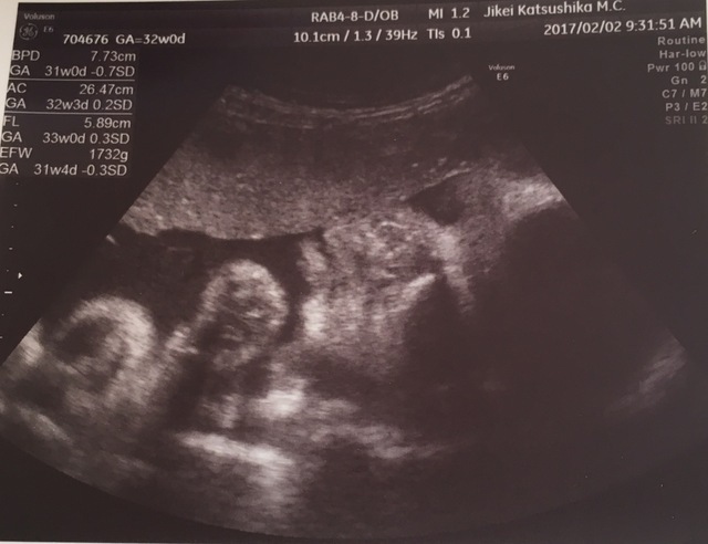 エコー写真 32週0日 32w0d 女の子,妊娠,32週,エコー写真