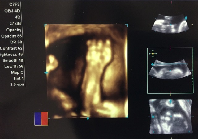 エコー写真 32週0日 32w0d 男の子,妊娠,32週,エコー写真