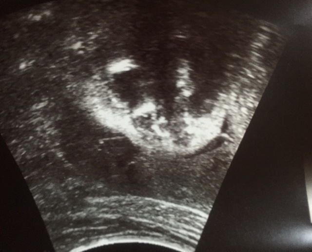 エコー写真 32週1日 32w1d 女の子,妊娠,32週,エコー写真