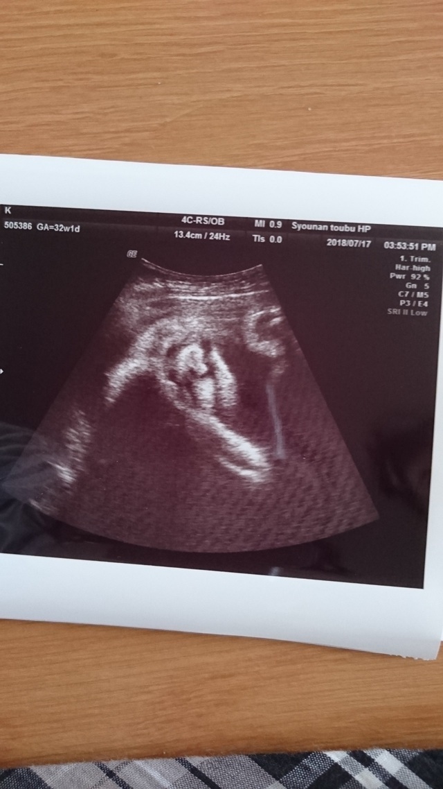 エコー写真 32週1日 32w1d 女の子,妊娠,32週,エコー写真