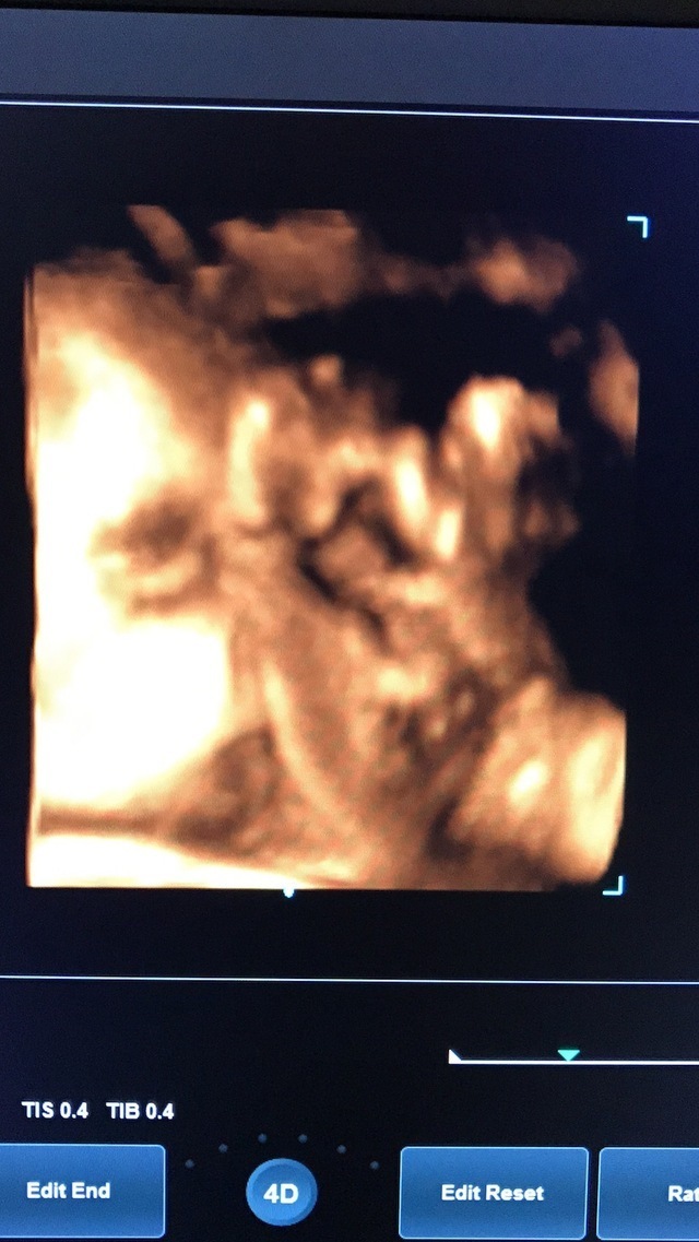 エコー写真 32週4日 32w4d 男の子,妊娠,32週,エコー写真