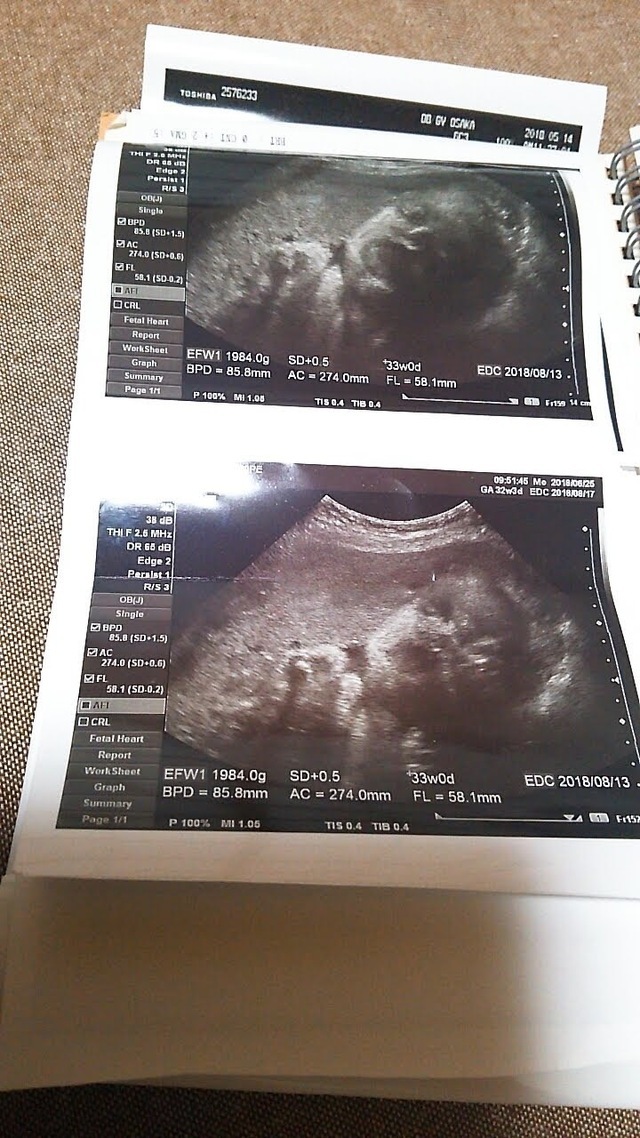 エコー写真 32週5日 32w5d 女の子,妊娠,32週,エコー写真