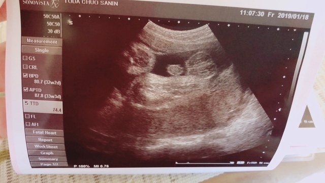 エコー写真 32週6日 32w6d 男の子,妊娠,32週,エコー写真