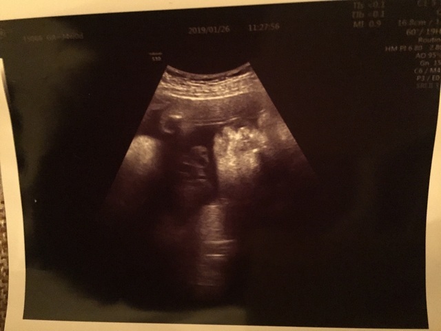 エコー写真 34週0日 34w0d 女の子,妊娠,34週,エコー写真