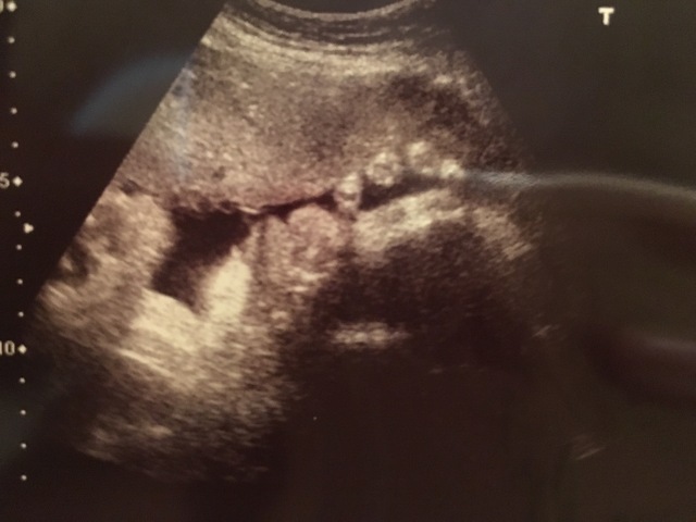 エコー写真 34週2日 34w2d 男の子,妊娠,34週,エコー写真