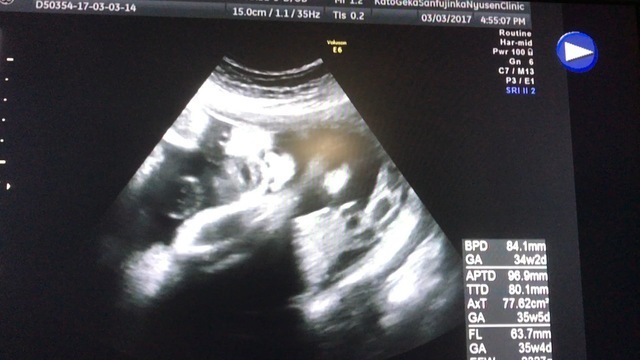 エコー写真 34週2日 34w2d 男の子,妊娠,34週,エコー写真