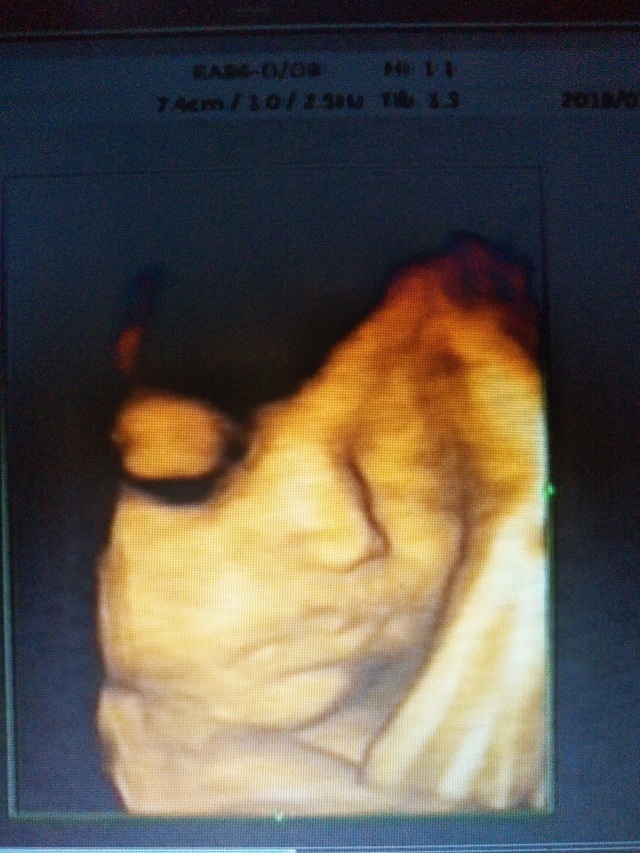 エコー写真 34週2日 34w2d 女の子,妊娠,34週,エコー写真
