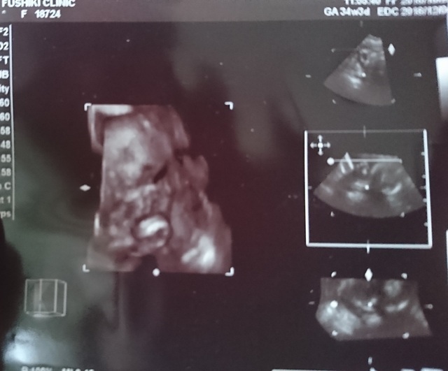 エコー写真 34週3日 34w3d 女の子,妊娠,34週,エコー写真