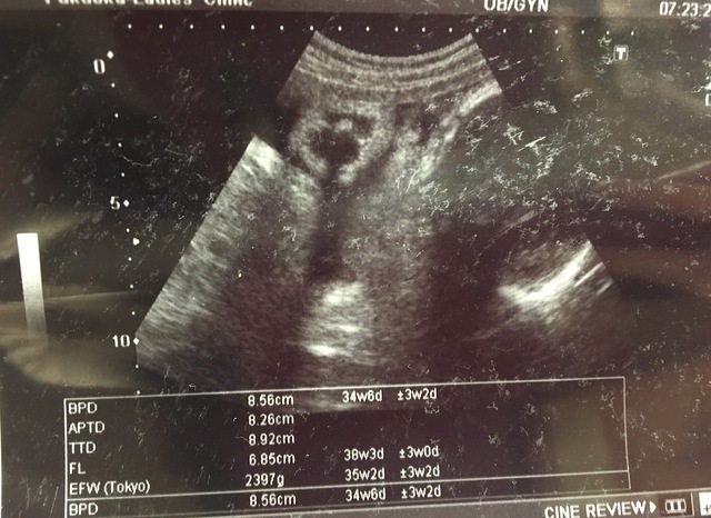 エコー写真 34週4日 34w4d 女の子,妊娠,34週,エコー写真