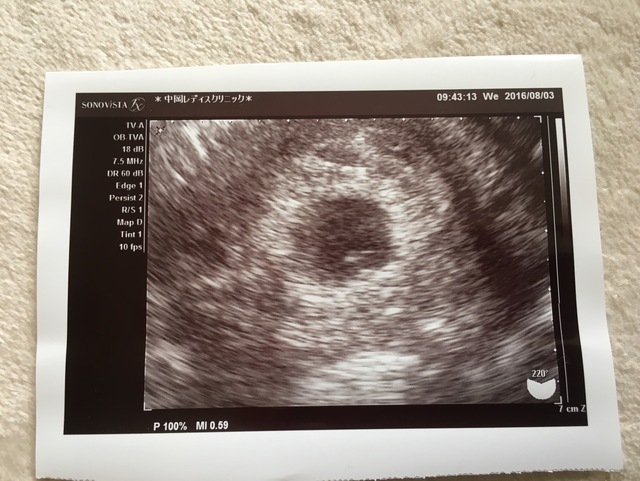 5週3日(5w3d・男の子),妊娠5週,エコー写真,