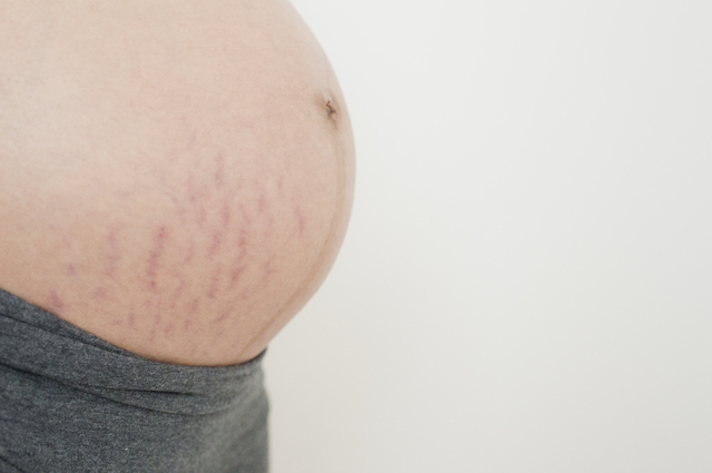 妊娠線,妊娠線,ケア,