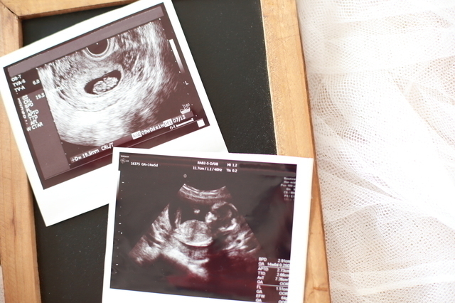 エコー写真,妊娠20週,